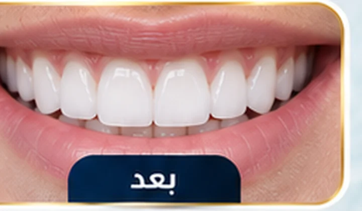 بعد تبييض الأسنان بالليزر
