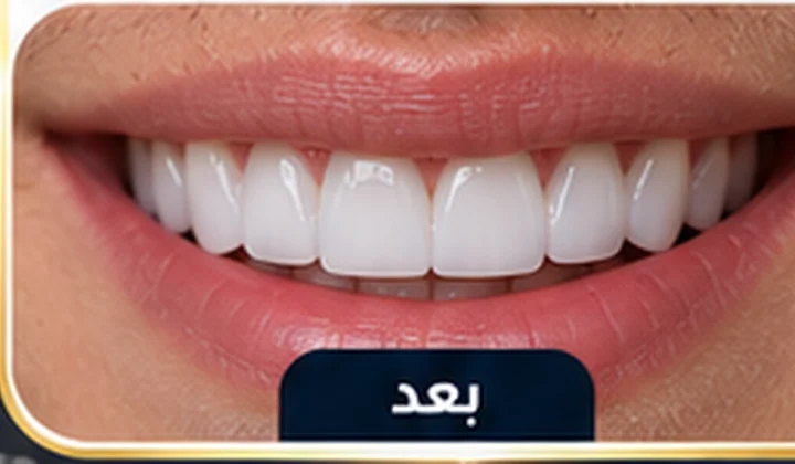 بعد هوليود سمايل