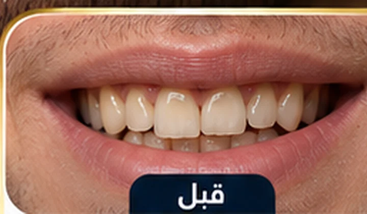 قبل هوليود سمايل