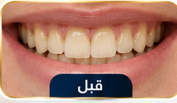 قبل تبييض الأسنان بالليزر