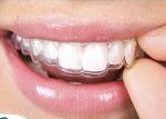 الأسنان الشفاف 150x150 1 e1650901886235