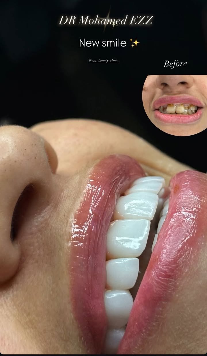 هوليود سمايل وفينير - Ezz Dental Clinic مدينة نصر