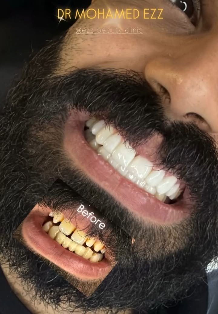 تركيبات الزيركون و E-max - Ezz Dental Clinic مدينة نصر