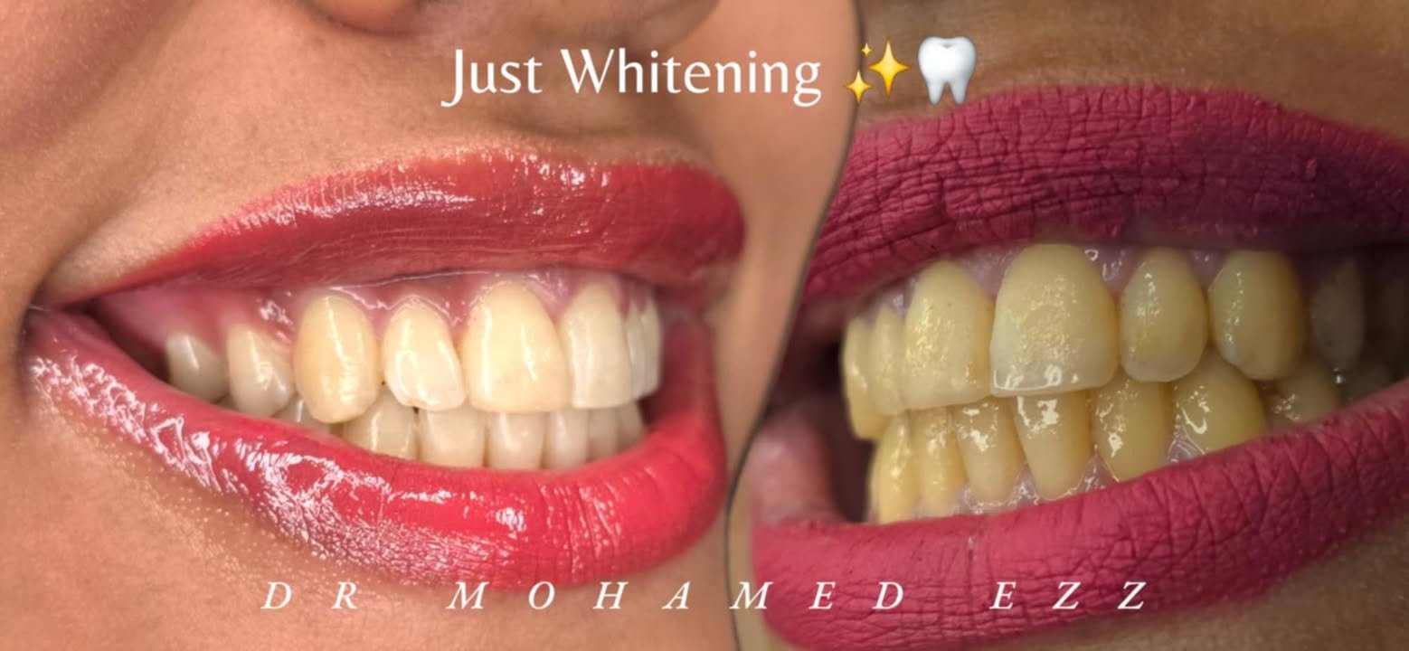 تبييض الأسنان بالليزر - Ezz Dental Clinic مدينة نصر
