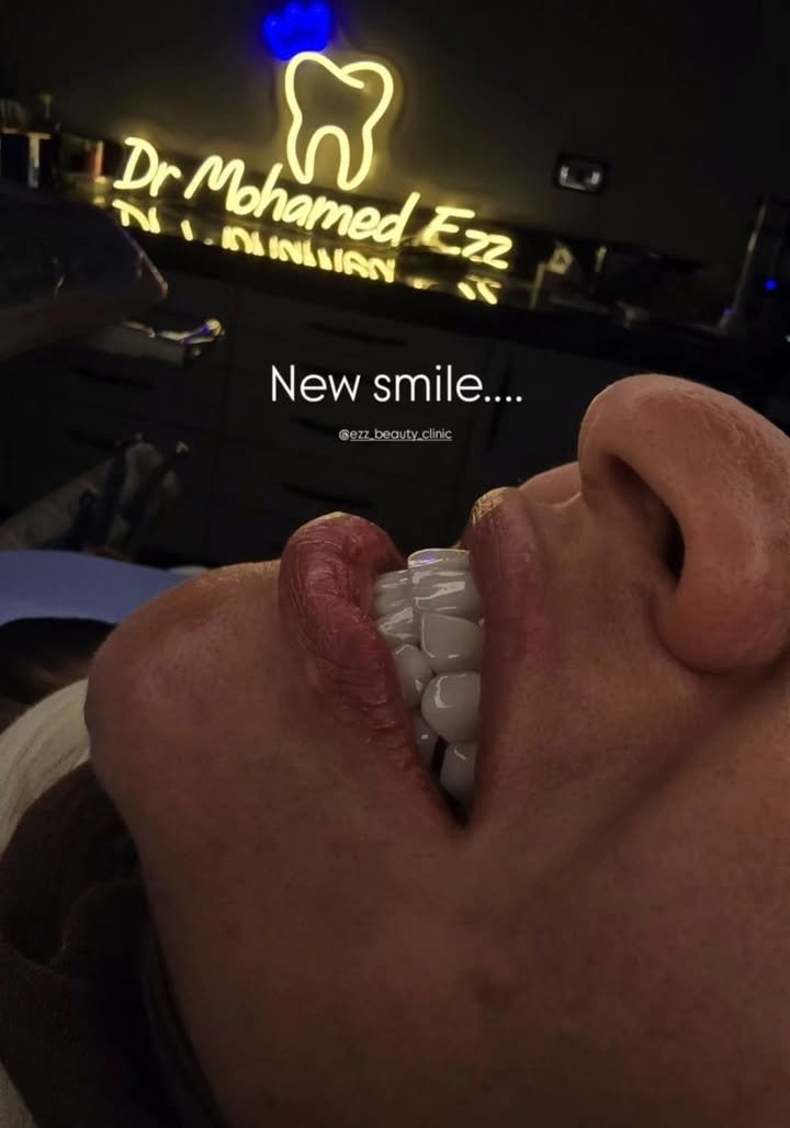 فينير الأسنان وتصميم الابتسامة - Ezz Dental Clinic مدينة نصر