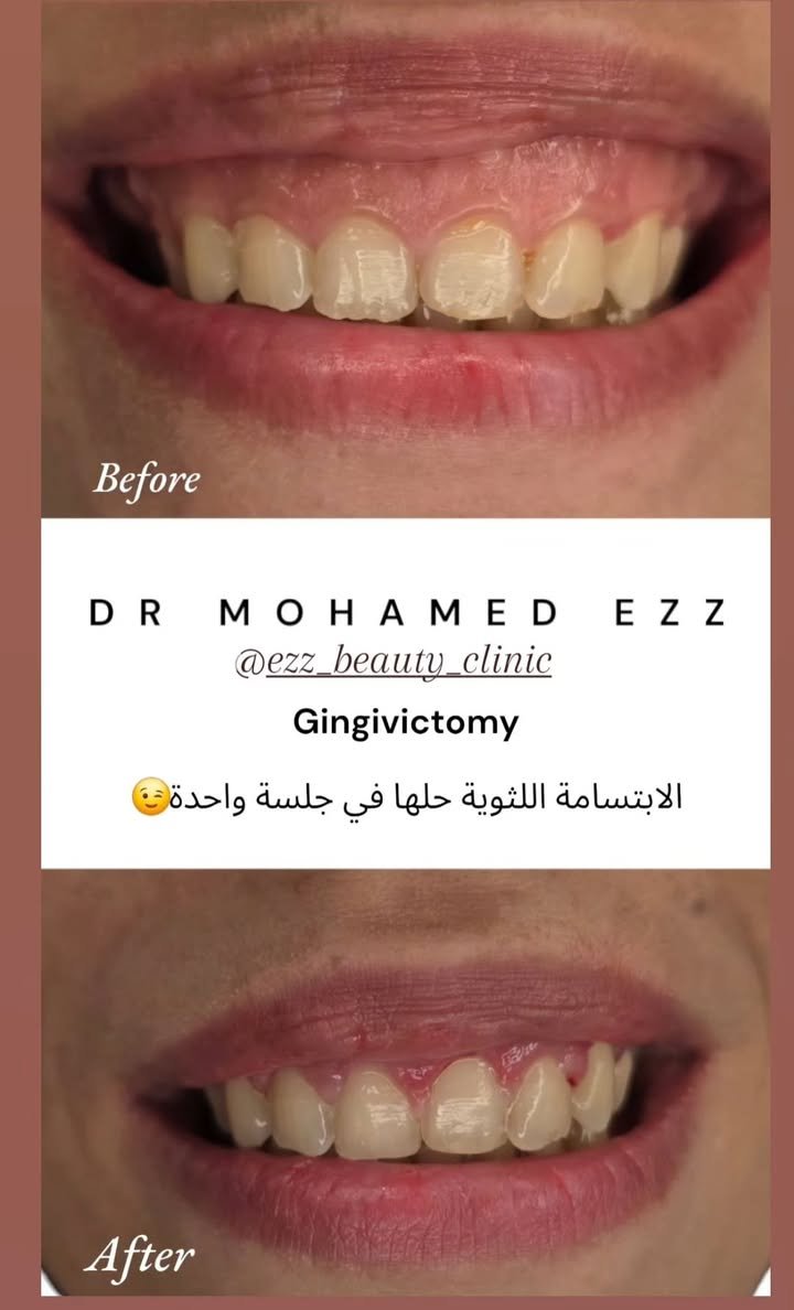 تجميل اللثة والابتسامة - Ezz Dental Clinic مدينة نصر
