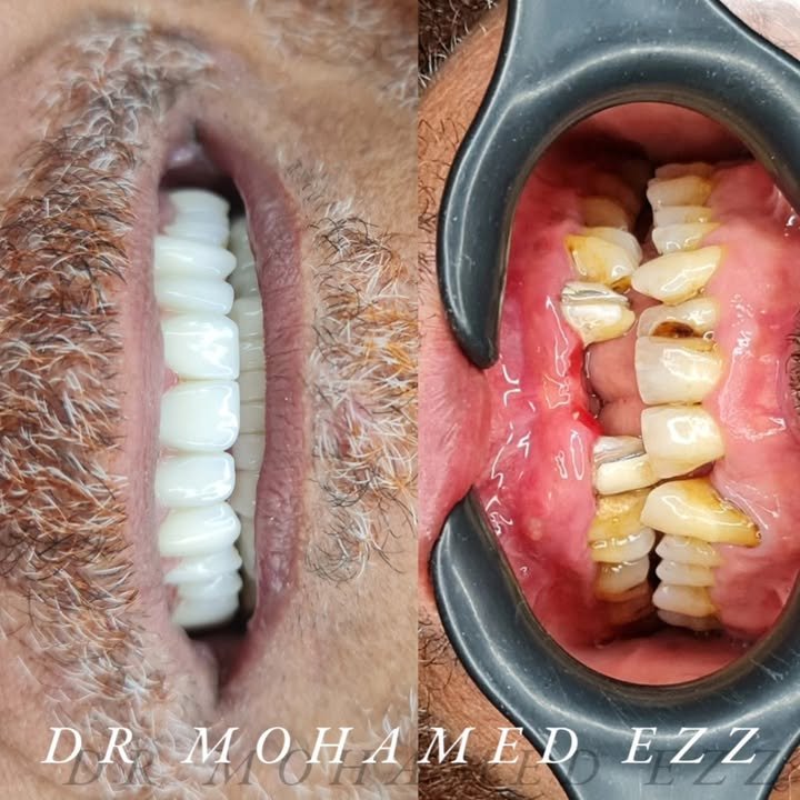 Hollywood Smile - Ezz Dental Clinic مدينة نصر