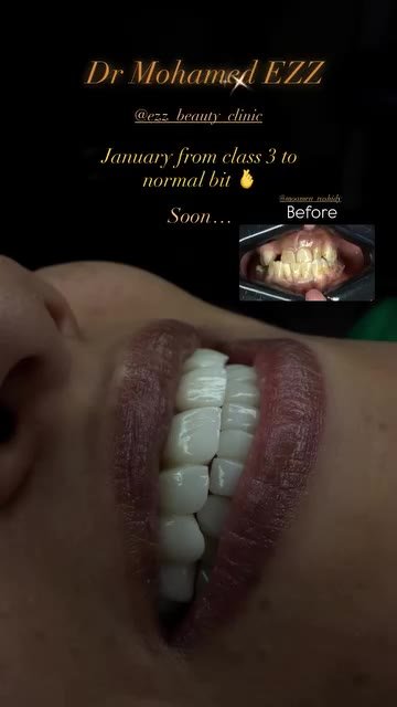 من حالات وابتسامات العيادة - Ezz Dental Clinic مدينة نصر
