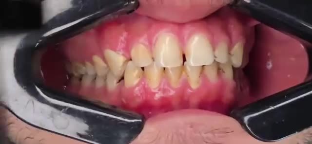 من حالات وابتسامات العيادة - Ezz Dental Clinic مدينة نصر
