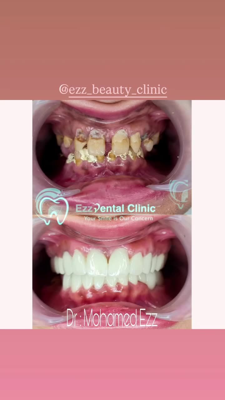 من حالات وابتسامات العيادة - Ezz Dental Clinic مدينة نصر