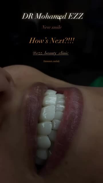 من حالات وابتسامات العيادة - Ezz Dental Clinic مدينة نصر