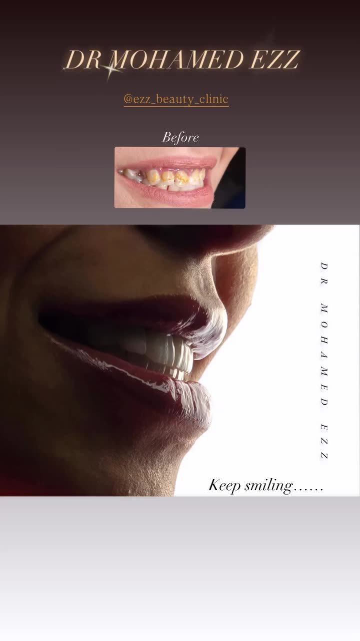 من حالات تجميل الابتسامة - Ezz Dental Clinic مدينة نصر