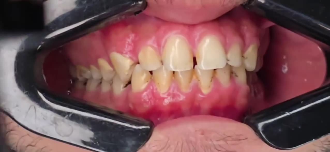 قفل الفراغات وتجميل الأسنان - Ezz Dental Clinic مدينة نصر