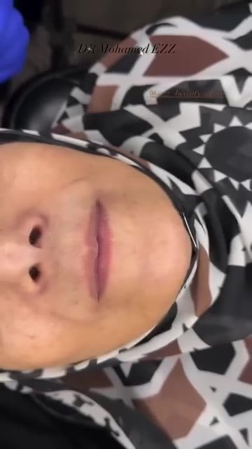 من حالات وابتسامات العيادة - Ezz Dental Clinic مدينة نصر