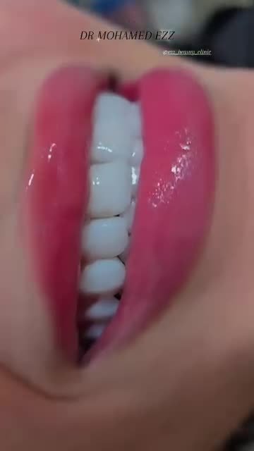 من حالات وابتسامات العيادة - Ezz Dental Clinic مدينة نصر