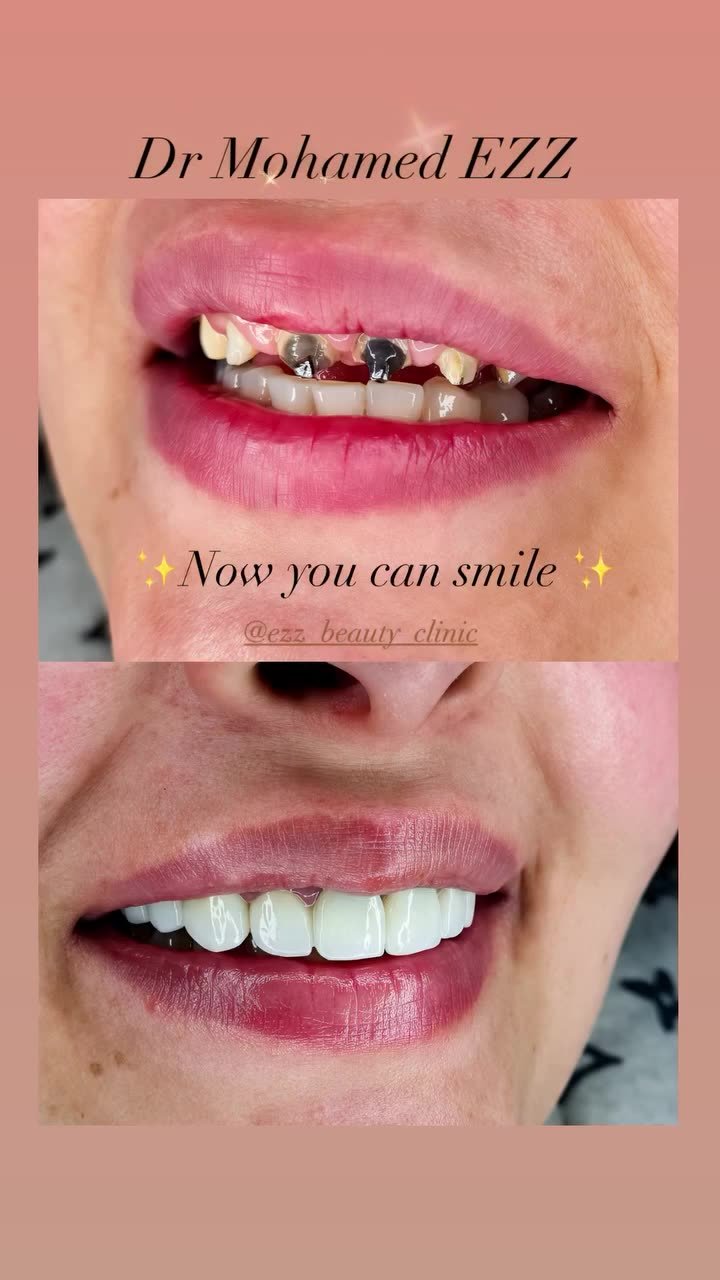 تجميل الابتسامة - Ezz Dental Clinic مدينة نصر