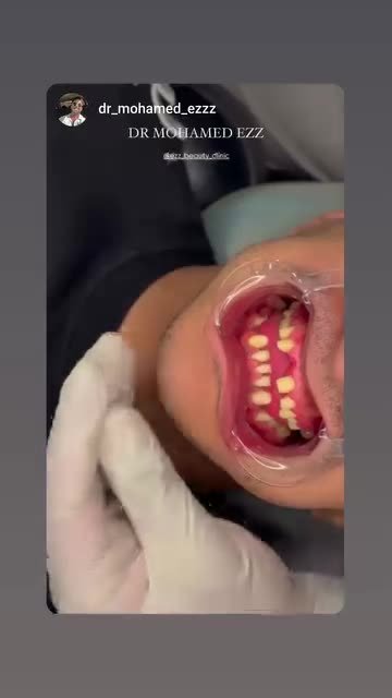 من حالات وابتسامات العيادة - Ezz Dental Clinic مدينة نصر