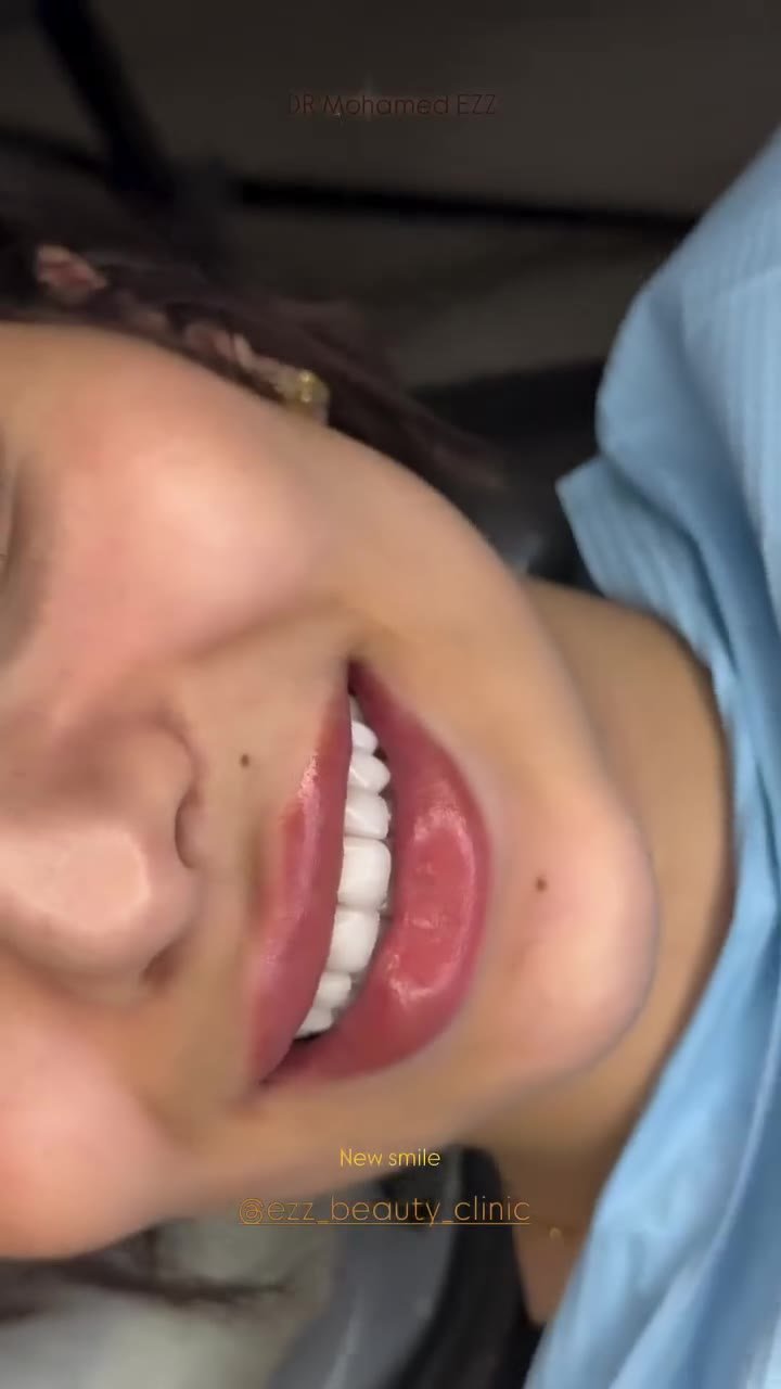 ابتسامة جديدة من العيادة - Ezz Dental Clinic مدينة نصر