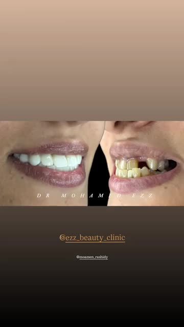 من حالات وابتسامات العيادة - Ezz Dental Clinic مدينة نصر