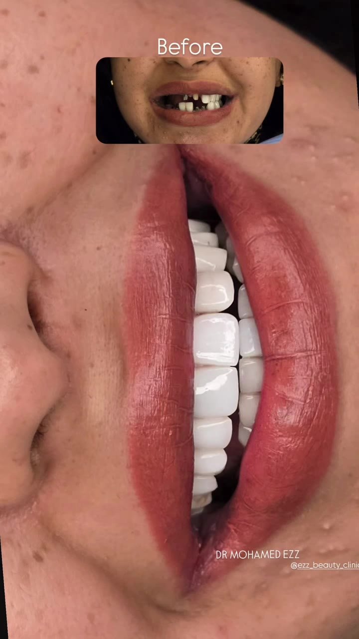 من حالات تجميل الابتسامة - Ezz Dental Clinic مدينة نصر