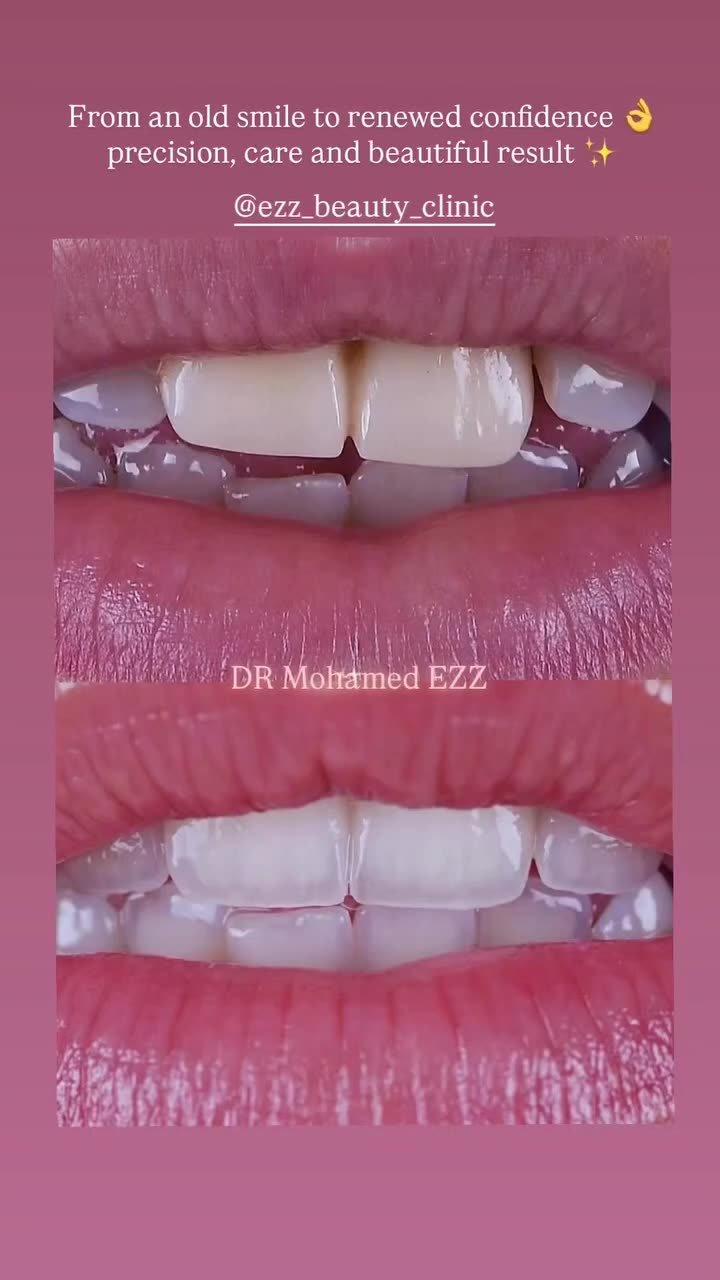 من حالات وابتسامات العيادة - Ezz Dental Clinic مدينة نصر
