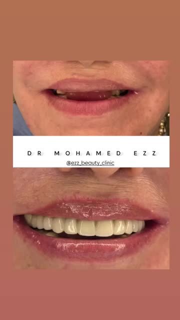 من حالات وابتسامات العيادة - Ezz Dental Clinic مدينة نصر