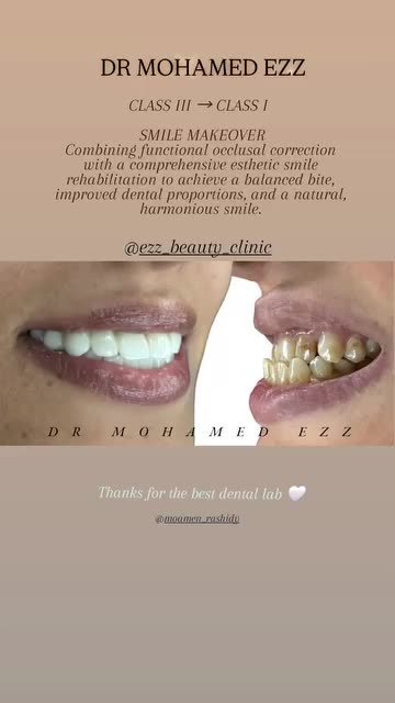 من حالات وابتسامات العيادة - Ezz Dental Clinic مدينة نصر