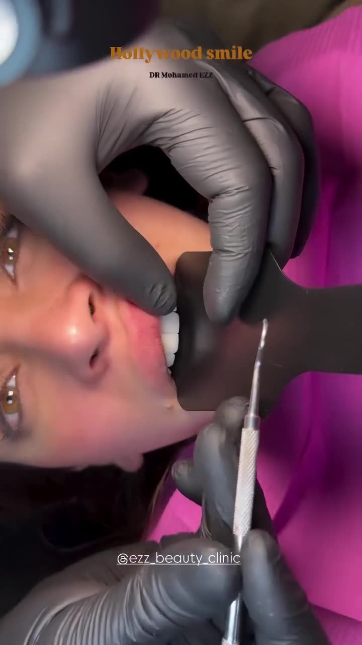 هوليود سمايل وتصميم الابتسامة - Ezz Dental Clinic مدينة نصر