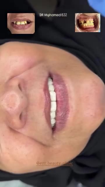 من حالات وابتسامات العيادة - Ezz Dental Clinic مدينة نصر