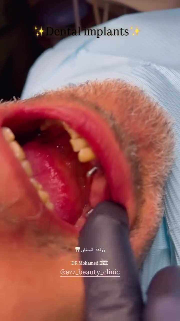 زراعة الأسنان وتعويض الأسنان المفقودة - Ezz Dental Clinic مدينة نصر